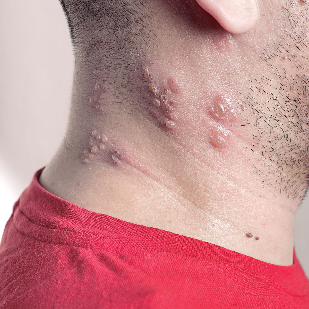 Herpes Zóster pode deixar cicatrizes